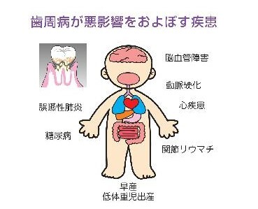 歯周病が全身に及ぼす影響.jpg