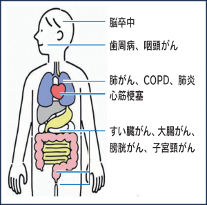 たばこによる影響で起こりやすい病気